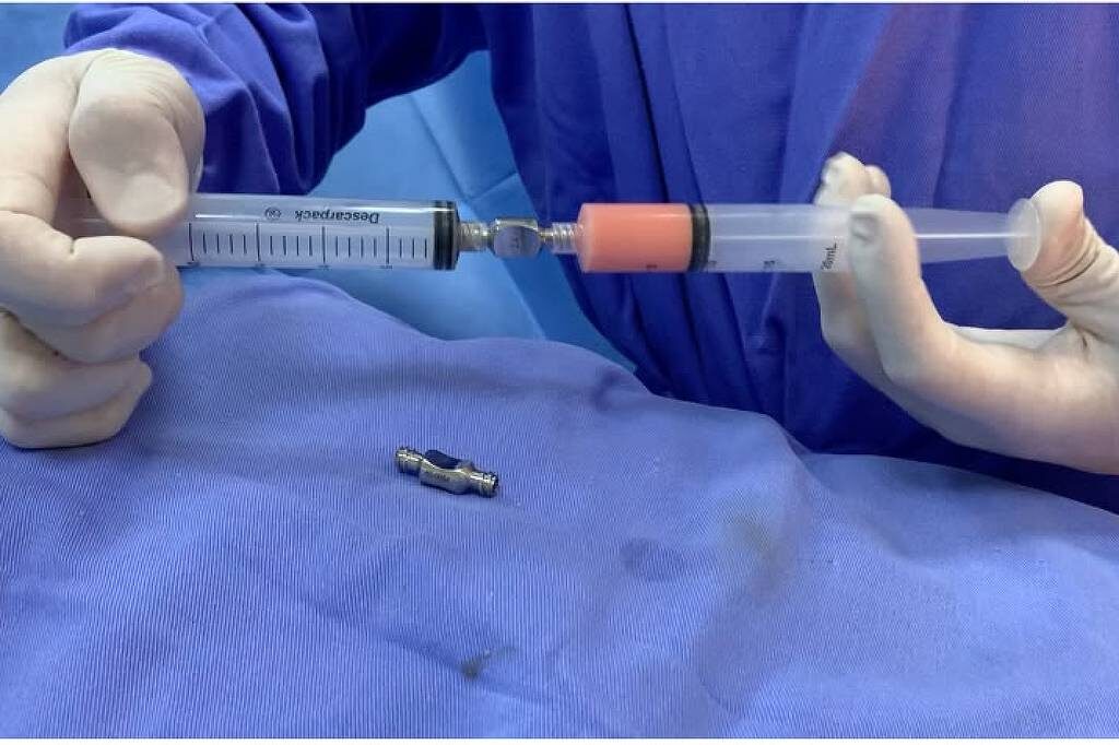 Tirar gordura do corpo e colocar no rosto pode rejuvenescer? Veja riscos e benefícios do nanofat